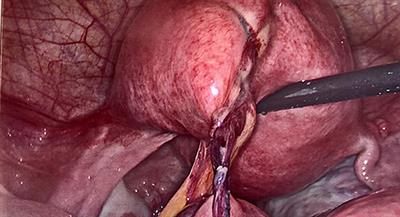 Case Report: Bowel Occlusion Following the Use of Barbed Sutures in Abdominal Surgery. A Single-Center Experience and Literature Review